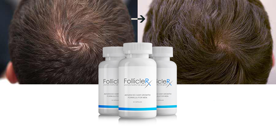 Follicle RX Review: Avancerad håråterställningsformel